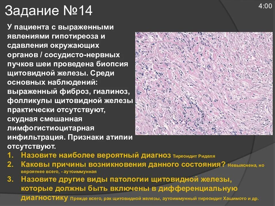 Папиллярная карцинома щитовидной железы гистология. Гиалиноз капсулы щитовидной железы патанатомия. Карцинома щитовидной железы патанатомия. Гиалиноз щитовидной железы патологическая анатомия макропрепарат. Папиллярный рак после операции