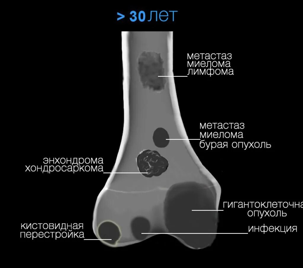 Очаговые изменения костей. Опухоли бедренной кости схема. Энхондрома бедренной кости кт. Опухоли бедренной кости на кт. Опухоль диафиза бедренной кости.