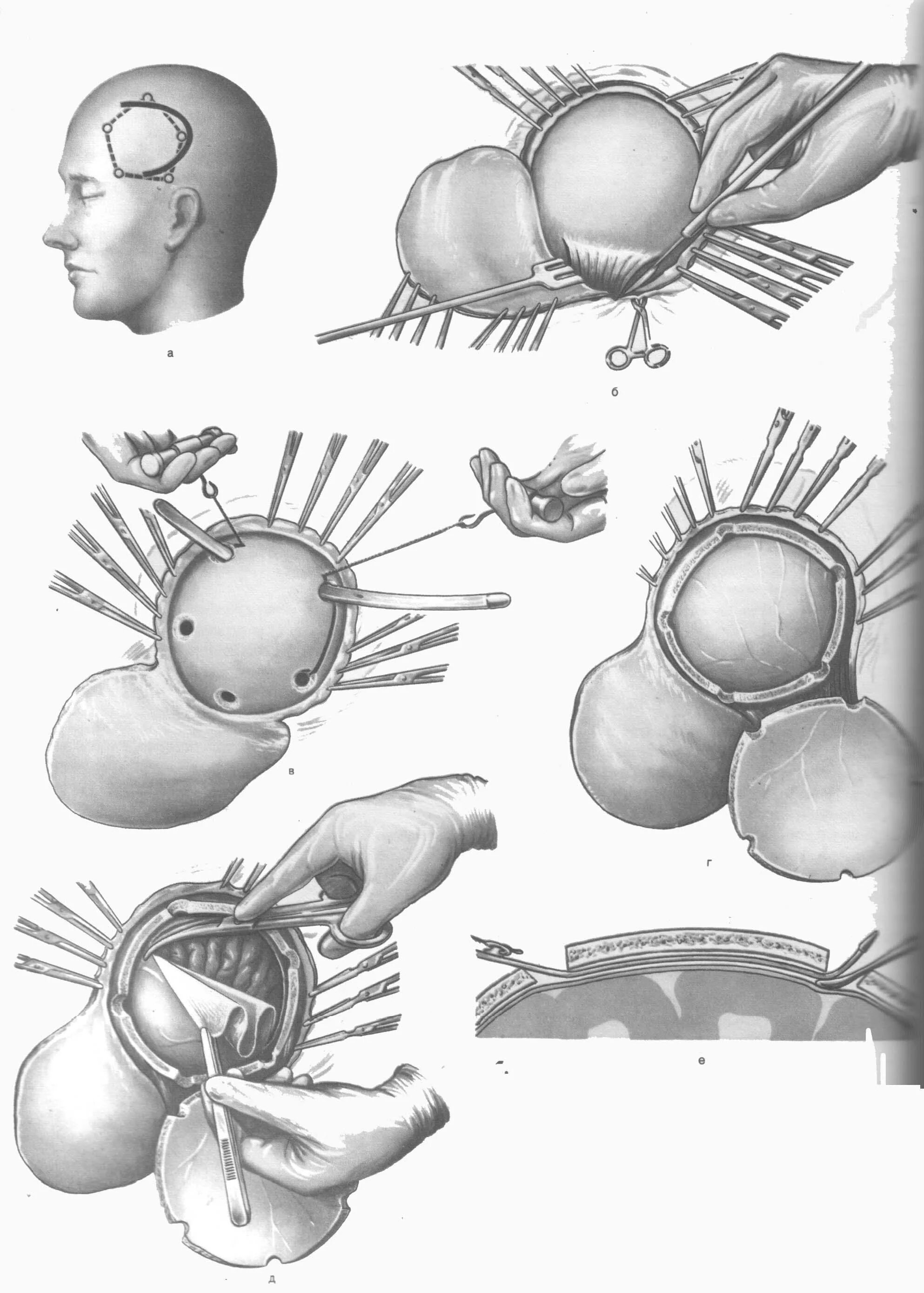 Костно-пластическая Трепанация черепа по Оливекрону. Резекционная Трепанация черепа. Костно-пластическая Трепанация черепа ход операции. Декомпрессивная Трепанация черепа.