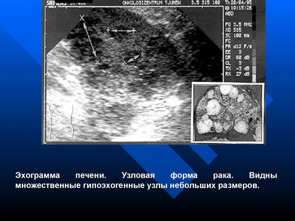 Множественные узлы в печени. Удаление опухолей печени