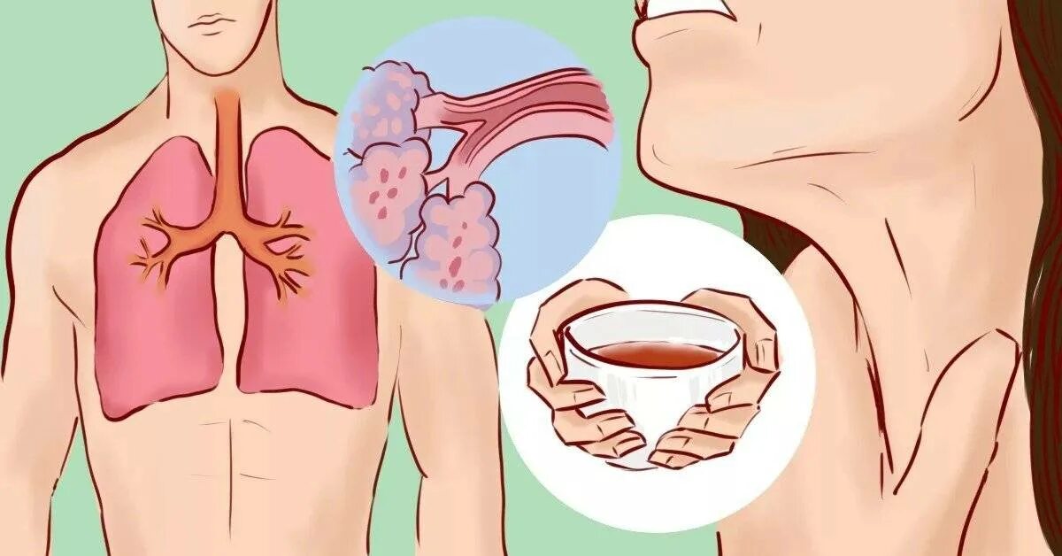 Как избавиться от мокроты без кашля. Вывод мокроты из бронхов и легких. мокрота в бронхах фото.