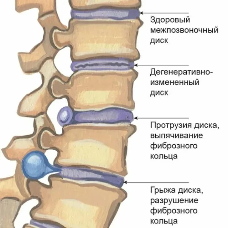 Спинные диски. Позвоночная грыжа лопаточного отдела. Грыжа позвоночника диска 4мм. Протрузии дисков позвоночника поясничного отдела. Грыжи и протрузии позвоночника.