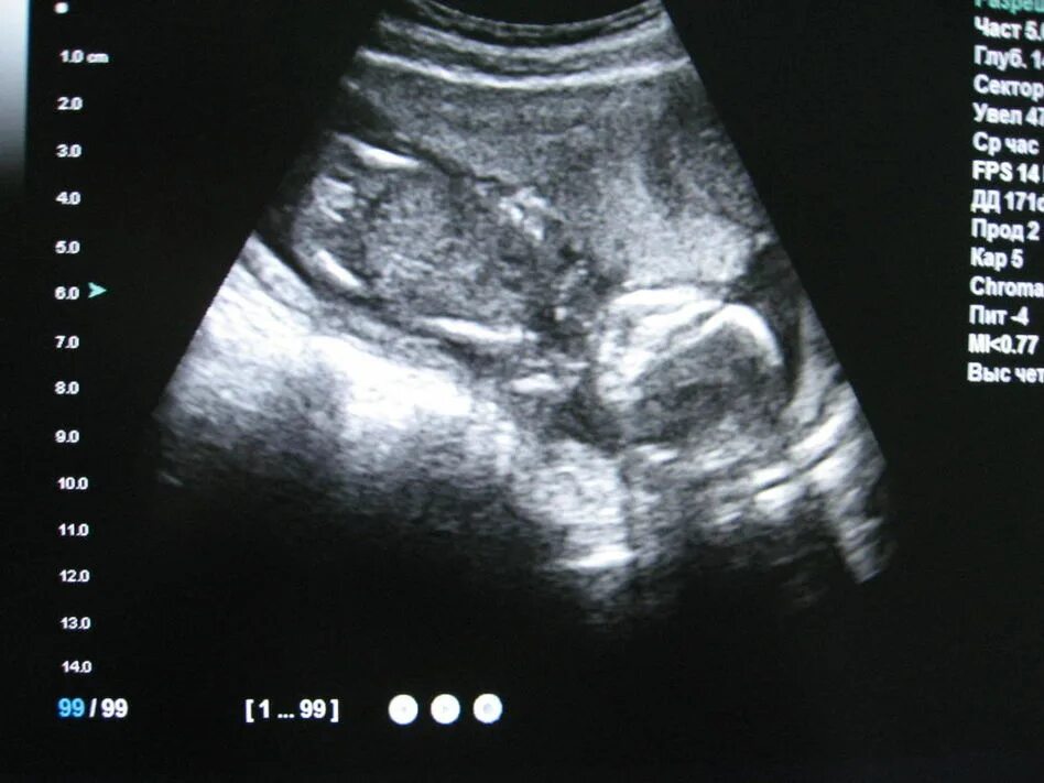 17 неделя 18 года. 17 неделя 18 года. Живот на 16-17 неделе беременности. 17 неделя беременности шевеление плода двойня. 17 неделя 18 года.