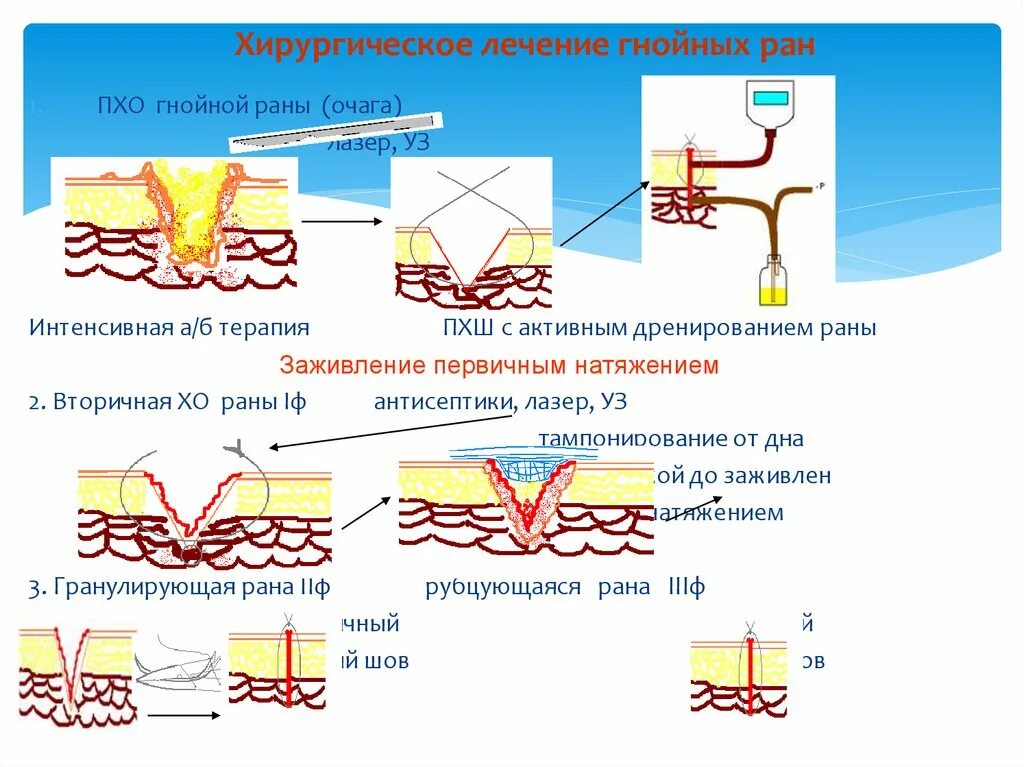 Этапы развития гнойной раны. Радикальная хирургическая обработка гнойной раны. Формирование хирургической раны. Стадии заживления гнойной раны. Чем можно обрабатывать швы после операции