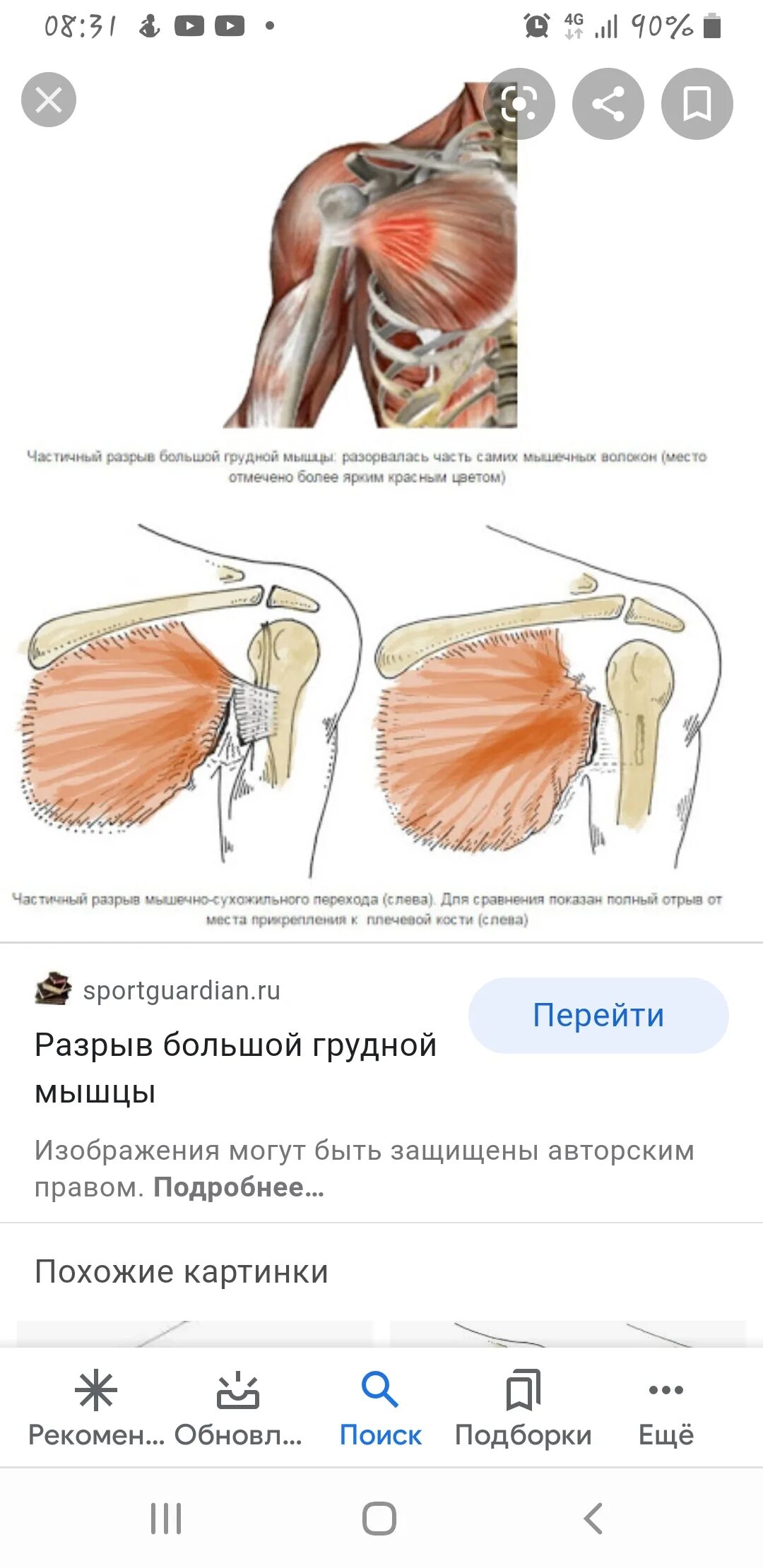 Частичный отрыв. Реинсерция сухожилия большой грудной мышцы. отрыв сухожилия большой грудной мышцы. разрыв сухожилия грудной мышцы. повреждение сухожилия грудной мышцы.