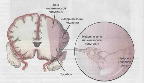 Зоны инсульта
