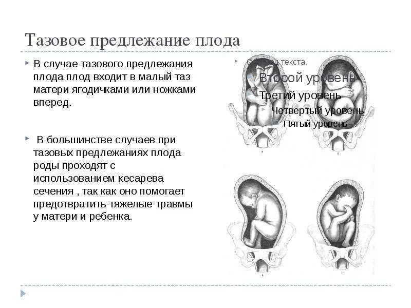 Предлежание головой. Тазовое предлежание на УЗИ. Продольное поперечное косое положение плода. Положение плода продольное предлежание головное. Неправильное головное предлежание.