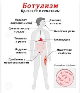 Отравление ботулизмом симптомы