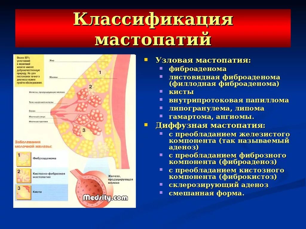 Фиброзно-кистозная болезнь молочной железы классификация. Гистология кистозная мастопатия. Фиброзная мастопатия молочной железы гистология. Узловая кистозная мастопатия молочных желез.