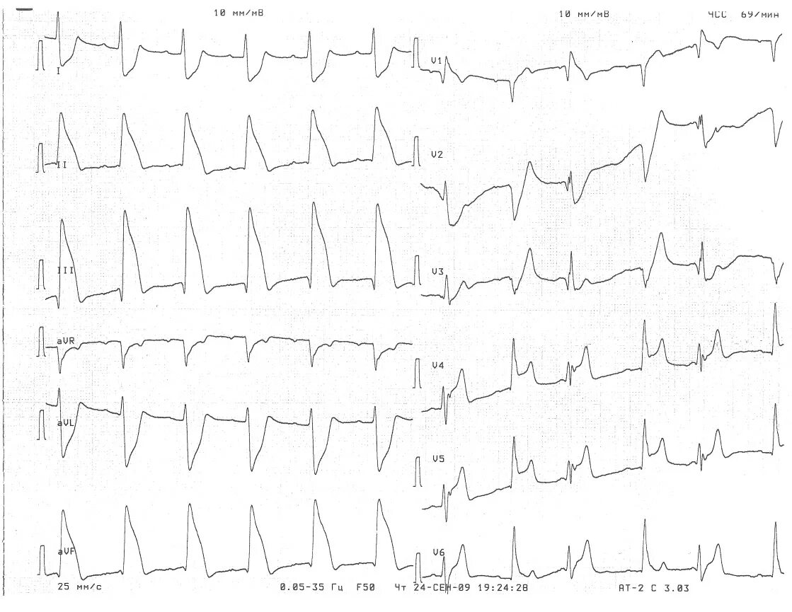 Очаговые изменения левого желудочка. Инфаркт миокарда Нижне боковой стенки ЭКГ. Инфаркт миокарда передней стенки лж ЭКГ. ЭКГ инфаркт миокарда экстрасистола. ЭКГ передне перегородочный инфаркт.