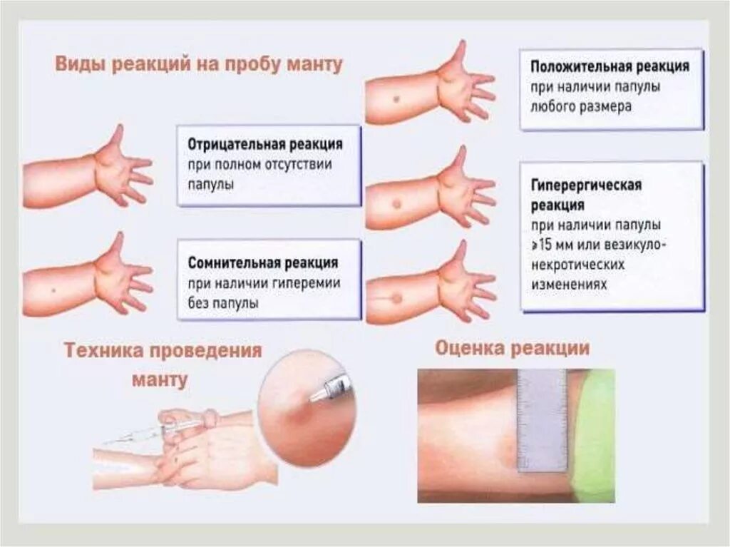 Резко положительная реакция. Реакция манту показатели нормы. Реакция ребенка на прививку манту в 1 год. Нормальные показатели реакции манту. Реакция манту норма у детей 10 лет.