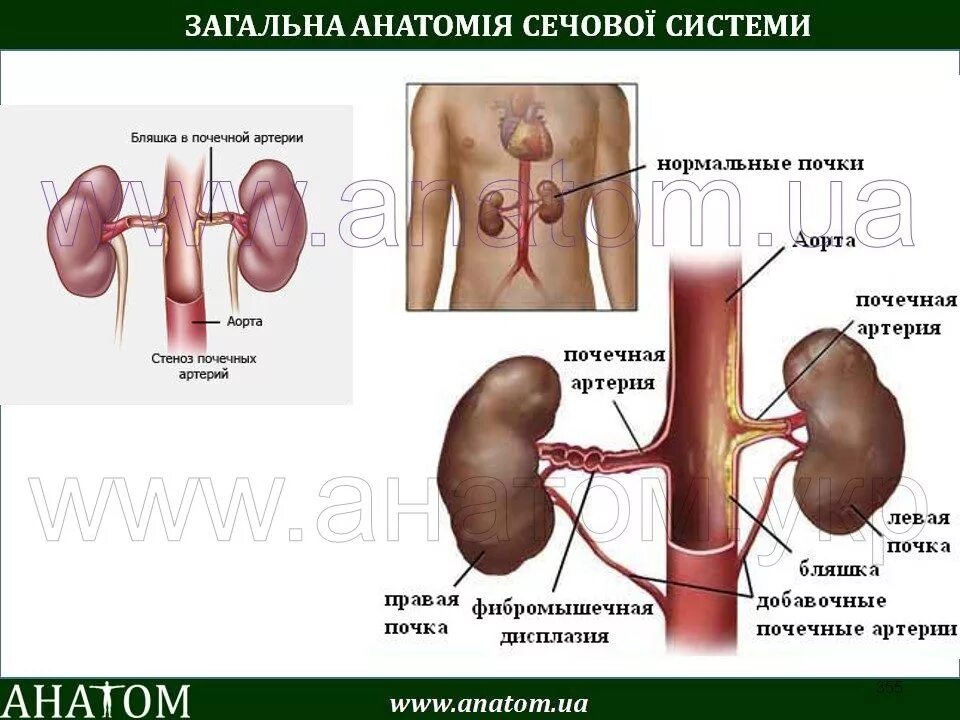 Дополнительная почечная артерия слева. Аберрантная почечная Вена это. Аберрантная почечная артерия.