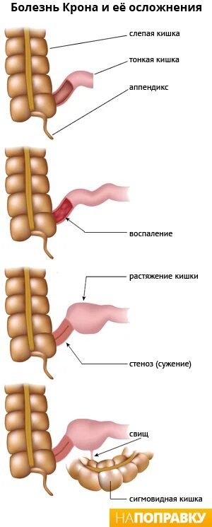 Стеноз кишечника что это. Стриктуры кишечника болезнь крона. Симптом булыжной мостовой кишечник. Болезнь крона сужение кишечника. Кишечная симптоматика болезни крона.