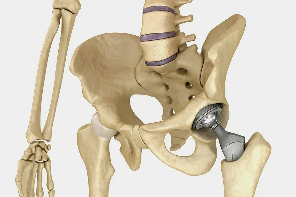 тазобедренные эндопротезы зиммер. анатомическая структура тазобедренного сустава. гемиартропластика тазобедренного сустава. эндопротез кости бедра. эндопротезирование тазобедренного сустава.
