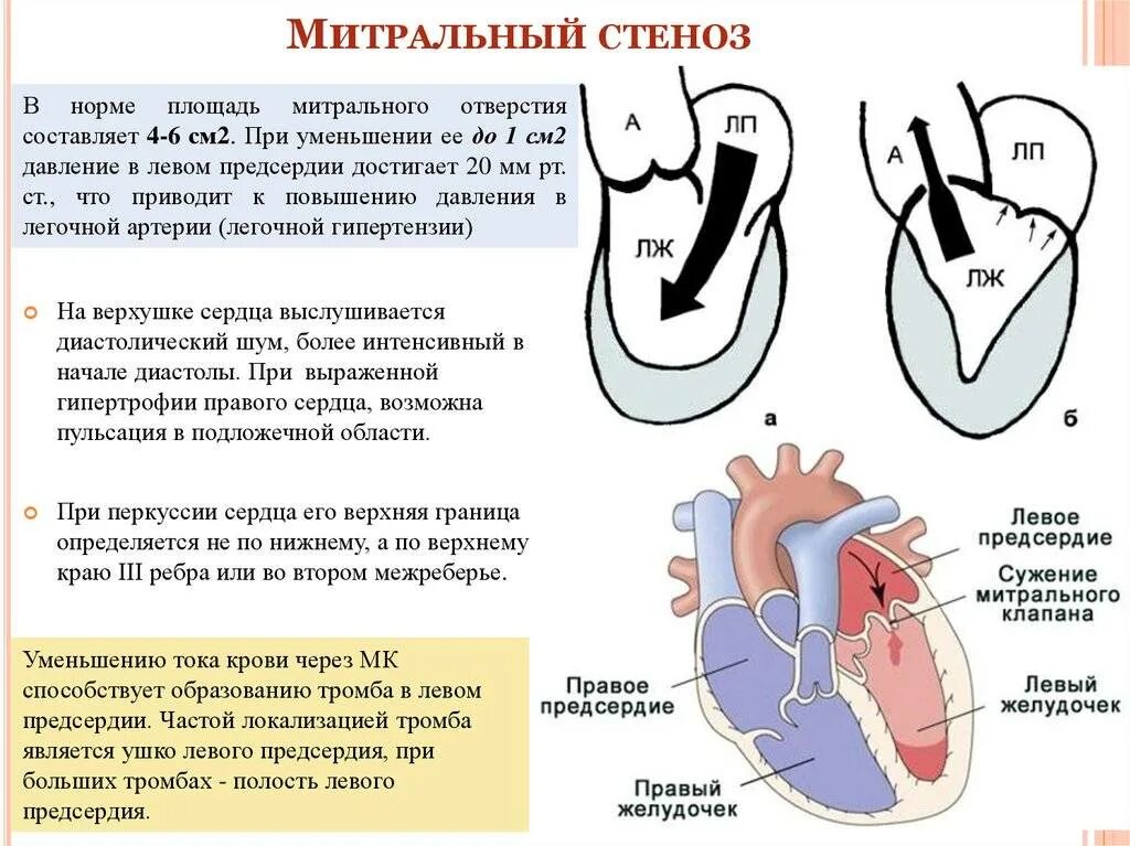 Давление в правом предсердии. Приобретенный порок сердца митральная недостаточность. Митральные пороки сердца схема. Стеноз митрального клапана гемодинамика схема. Недостаточность митрального клапана схема.