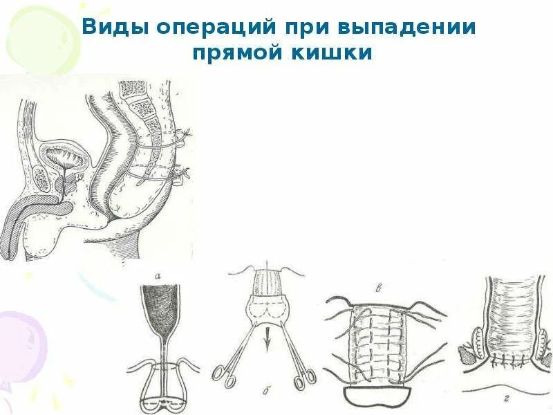 Почему выпадает кишка. Выпадение прямой кишки хирургия. Операции при выпадении прямой кишки. Выпадение прямой к шки. Выпадение слизистой прямой кишки.