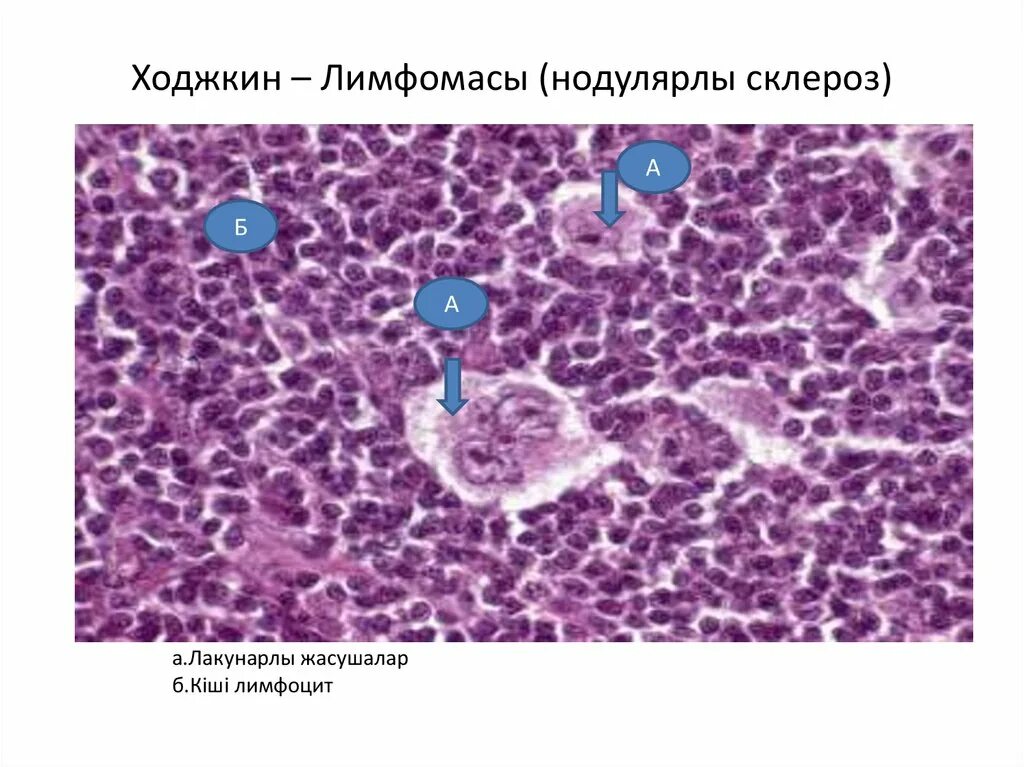 Классическая лимфома ходжкина нодулярный склероз. Лимфогранулематоз гистология нодулярный склероз. Клетки ходжкина гистология. Нодулярный склероз при болезни ходжкина. Классическая лимфома ходжкина нодулярный склероз.