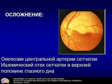 Окклюзия артерии