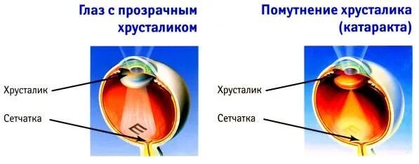 Когда меняют хрусталик. Катаракта схема глаза. катаракта (помутнение хрусталика) может возникнуть при. причины заболеваний хрусталика.. помутнел хрусталик глаза.