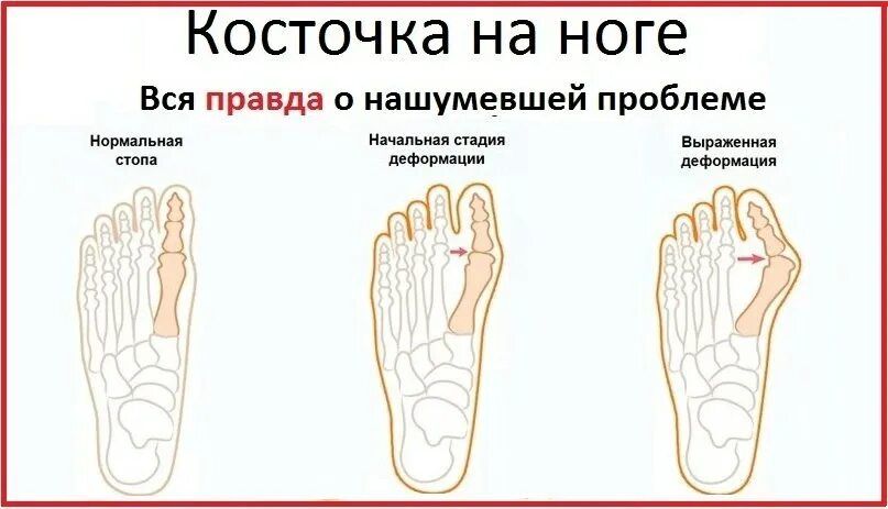 Кость на большом пальце ноги. Косточка на ноге у большого пальца. Косточка на ноге у большого пальца. Вальгусная деформация большого пальца стопы( hallux valgus. Вальгус болит косточка.
