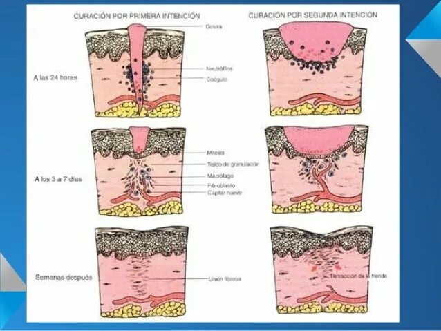 Через сколько заживает рана. Стадии заживления глубоких РАН. Процесс заживления раны. Этапы заживления глубокой раны.