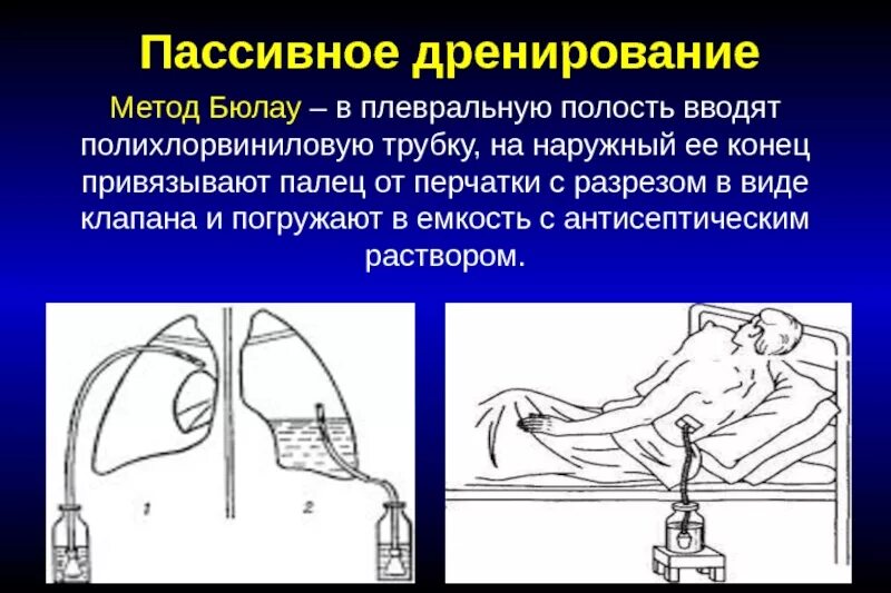 Пневмоторакс дренирование плевральной. Дренирование легкого пневмоторакс. Активное дренирование пневмоторакса. Пневмоторакс пункция плевральной полости.