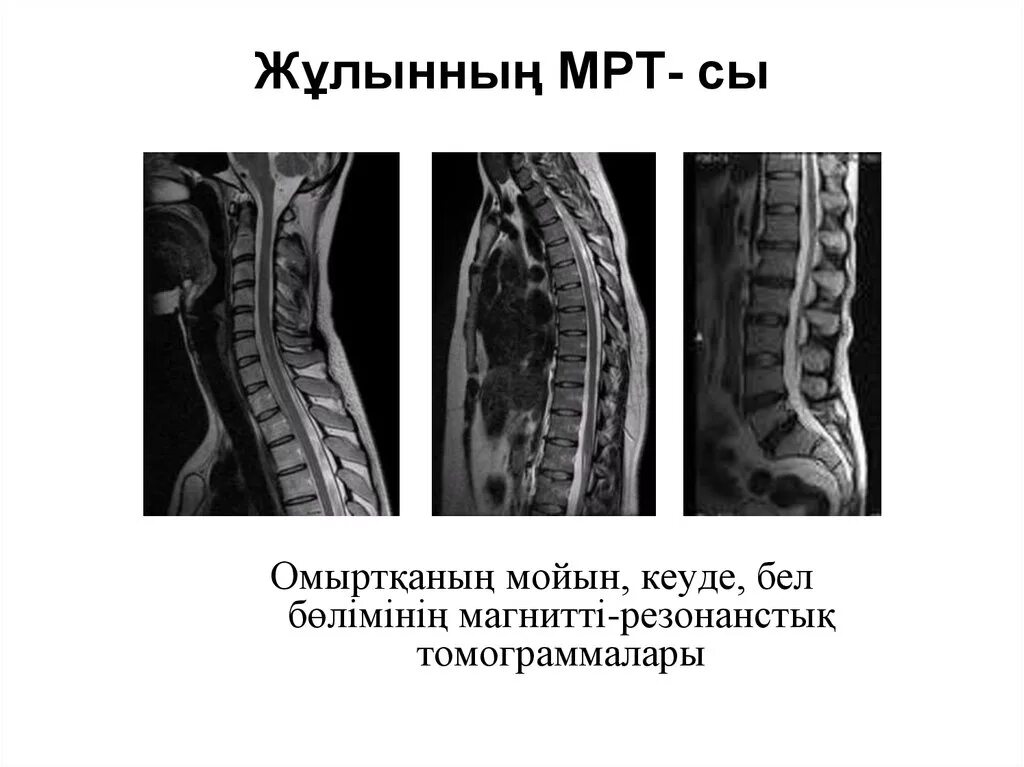 Мрт спинного мозга норма. Остеохондроз грудного отдела мрт. Демиелинизация спинного мозга мрт. Мрт спинного мозга грудной отдел.