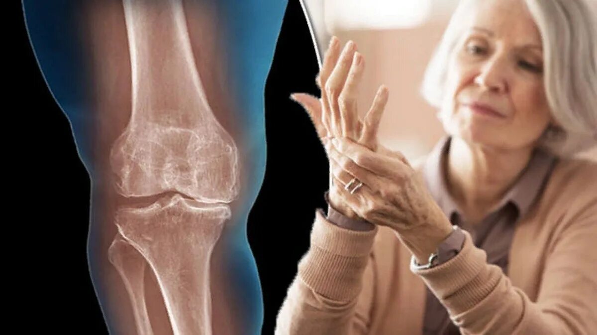 Болезнь суставов коленей. Ревматоидный артрит с доа это. Остеоартрит (артроз, дегенеративные заболевания суставов). Ревматоидный артрит и остеоартрит.