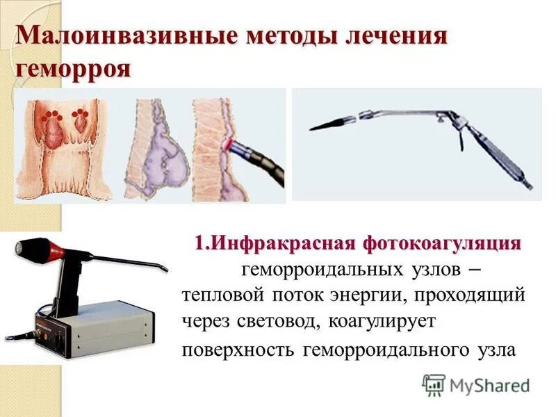 Лечение геморроя лазером в Санкт-Петербурге - цены в Выборгском районе Клиника М