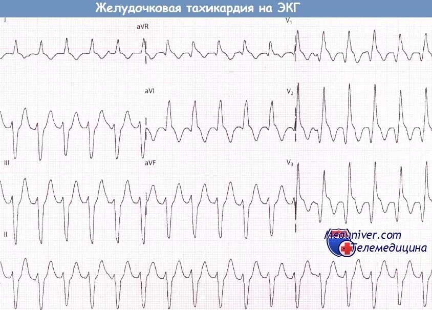 Желудочковая тахикардия на экг. Комплексы захвата при желудочковой тахикардии ЭКГ. Желудочковая тахикардия атлас ЭКГ. ЖТ на ЭКГ. Двунаправленная желудочковая тахикардия на ЭКГ.