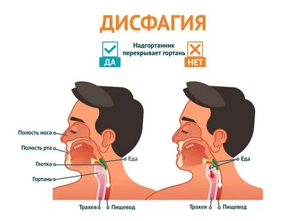 Спазмы горла после