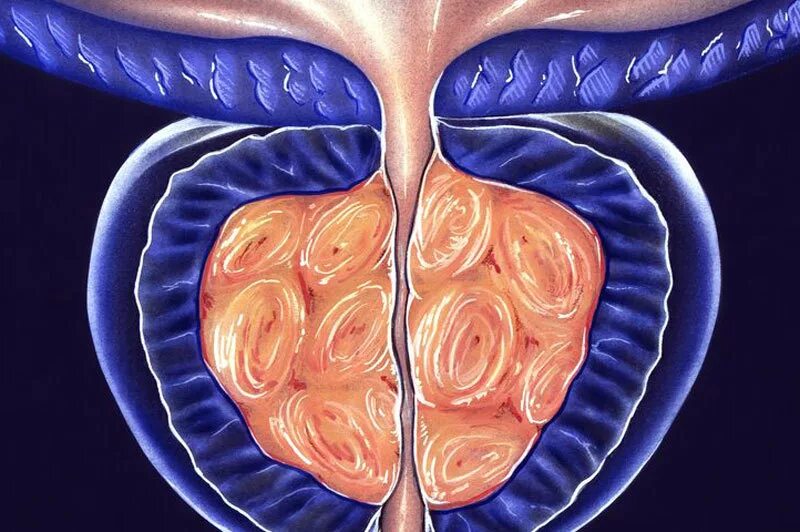 Забрюшинный фиброз болезнь ормонда. Фиброз предстательной железы на узи. Кальцинат предстательной железы узи. Кальцинаты в простате на узи. Узи трузи предстательной железы.