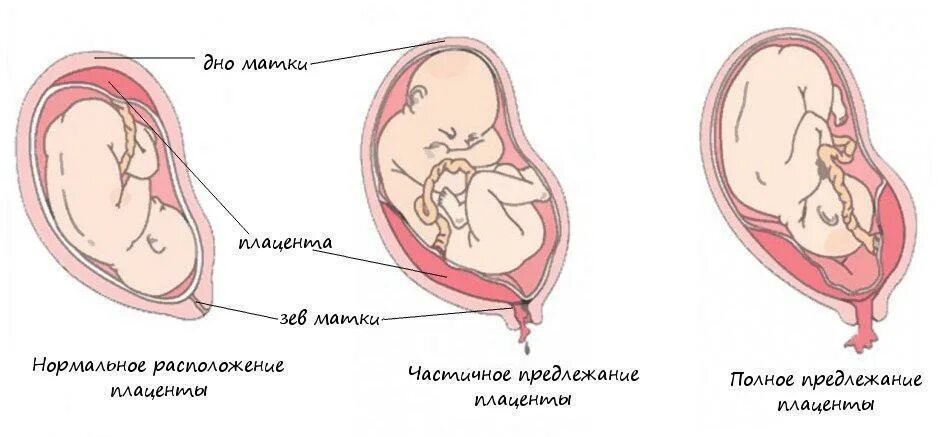 7мм предлежание плаценты. Полная отслойка предлежащей плаценты. Плацента и внутренний зев. Предлежание плаценты классификация по УЗИ. При низкой плацентации можно