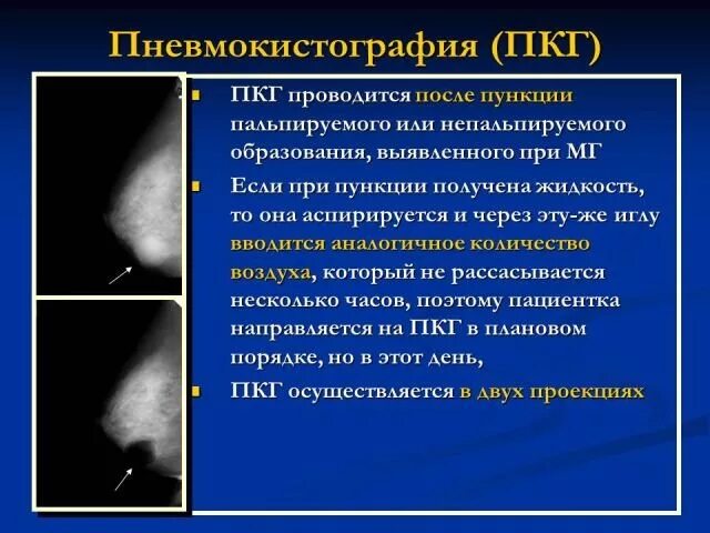 Маммография в двух проекциях. Маммограмма молочных желез. Маммография боковая проекция. Маммография периодичность