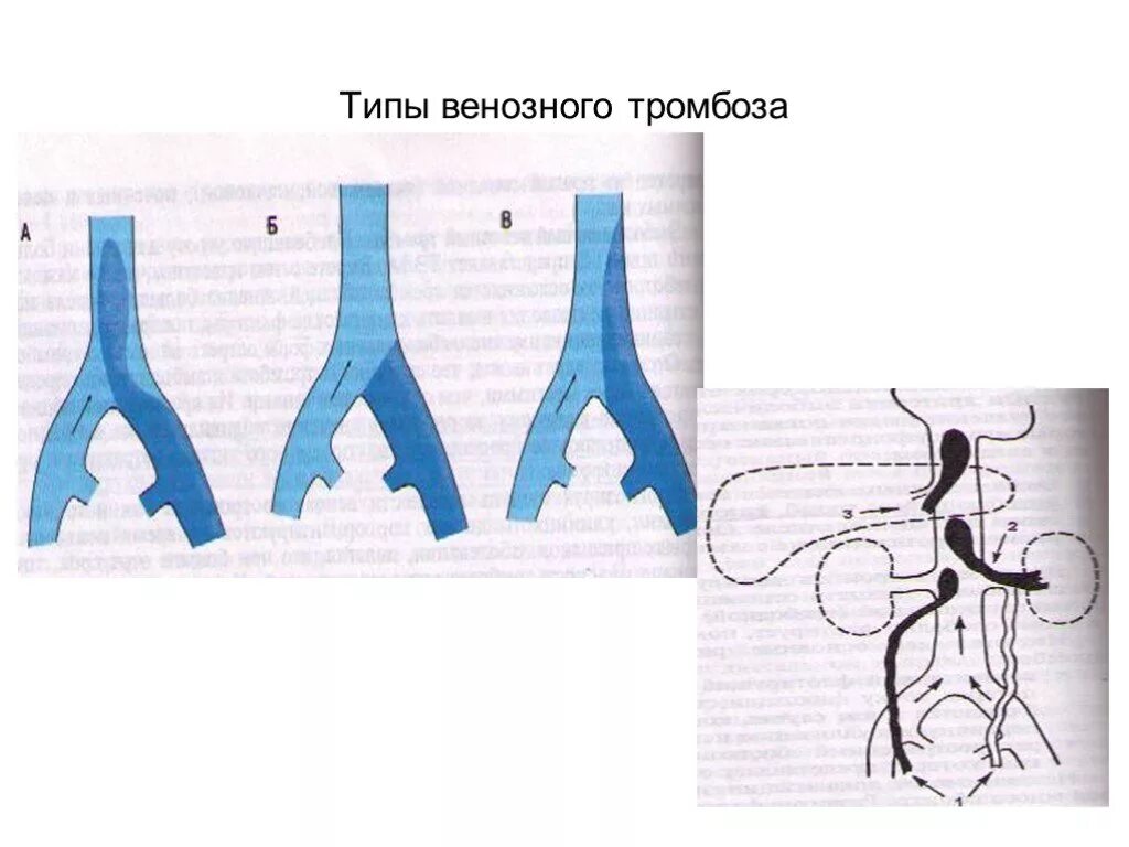 Окклюзивный и неокклюзивный тромбоз. Неокклюзирующий пристеночный тромбоз. Пристеночный тромбоз