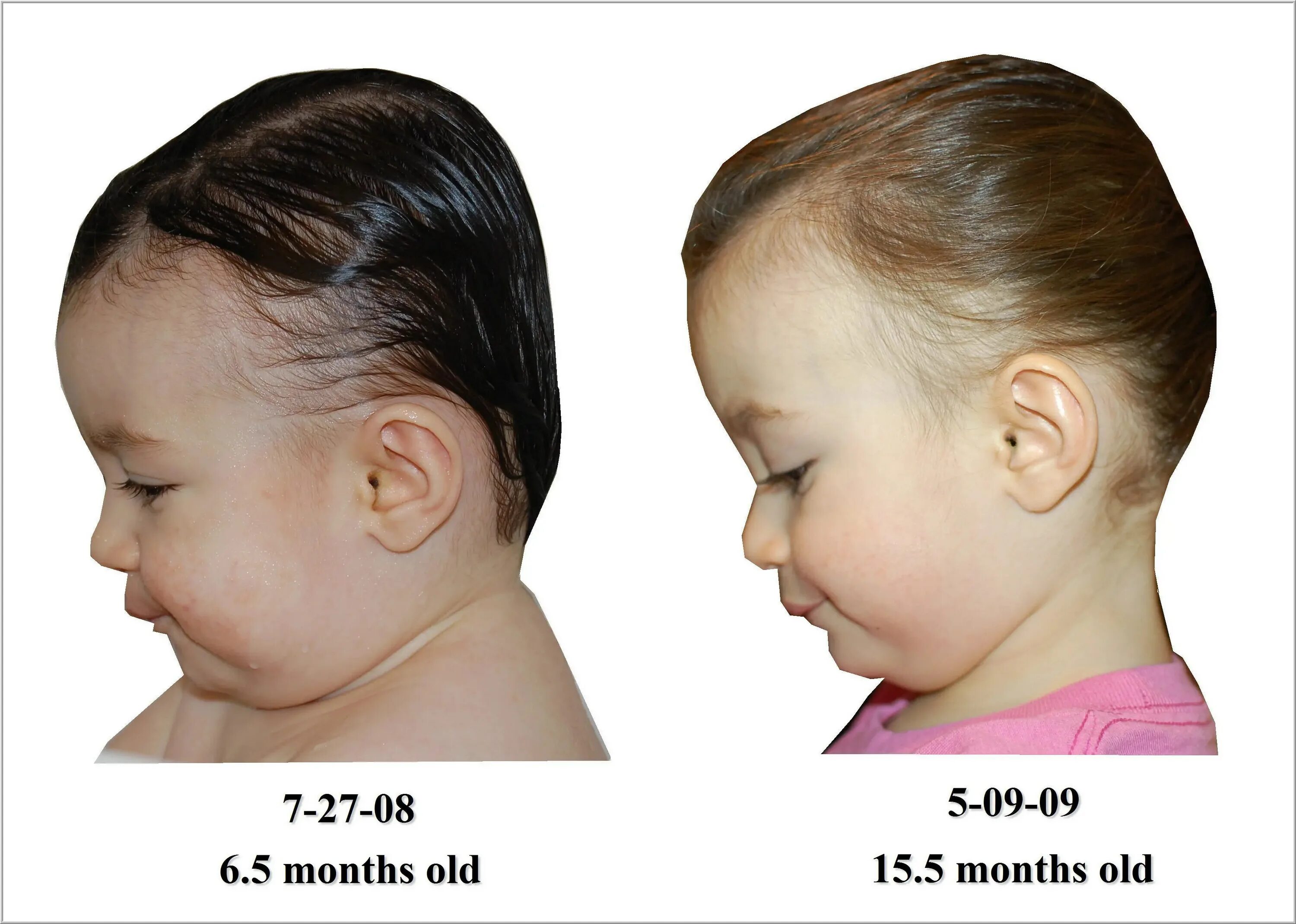 Краниостеноз оксицефалия. Как исправить форму головы. Брахицефалическая форма головы у ребенка. Как исправить форму головы. Краниосиностоз плагиоцефалия.