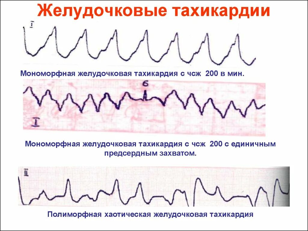 Желудочковая тахикардия на экг. Пароксизмальная желудочковая тахикардия на ЭКГ. Пароксизмальная мономорфная желудочковая тахикардия ЭКГ. Полиморфная желудочковая тахикардия ЭКГ.