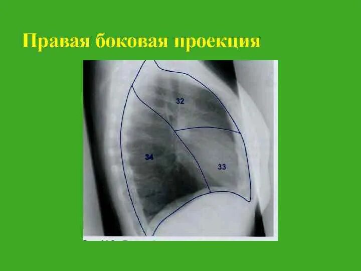 Левая боковая проекция. Легкие в боковой проекции. Проекция легких. Боковая проекция легких схема. Легкие в прямой проекции