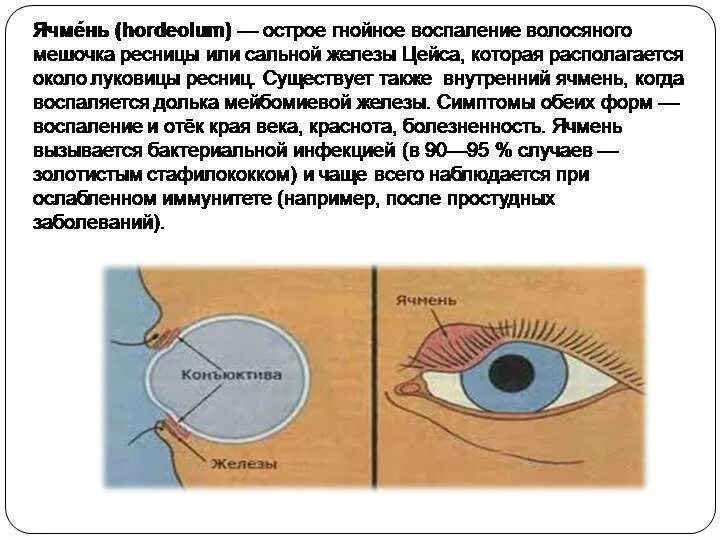 Ячмень что делать в домашних. Заболевания век ячмень. Как выглядит ячмень на глазу.