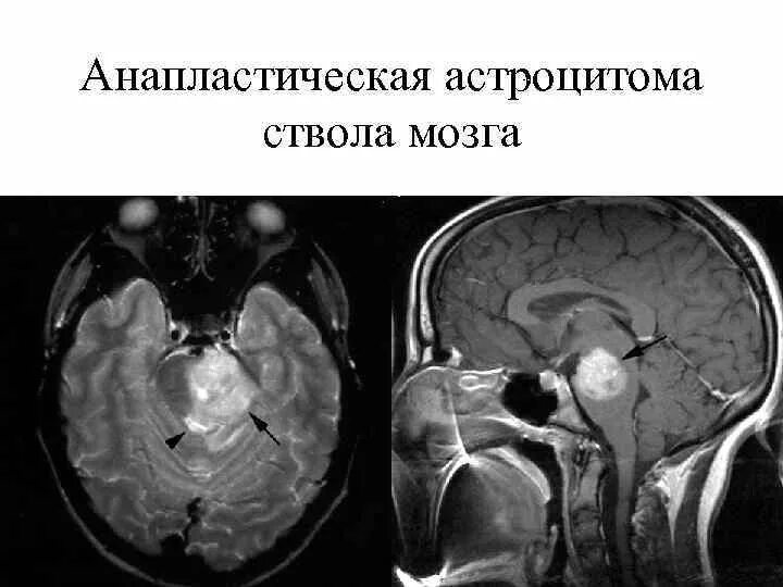 Анапластическая астроцитома ствола головного мозга. Астроцитома ствола мозга мрт. Мультифокальная анапластическая астроцитома. Глиома ствола головного.