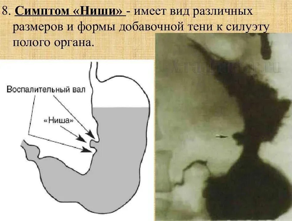 Симптом ниши. Рентген язвы желудка симптом ниши. Симптом ниши определение. Симптом ниши. Симптом ниши при язвенной болезни желудка рентген.