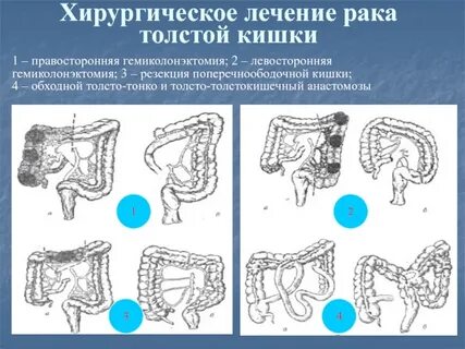 Хирургическое лечение прямой кишки