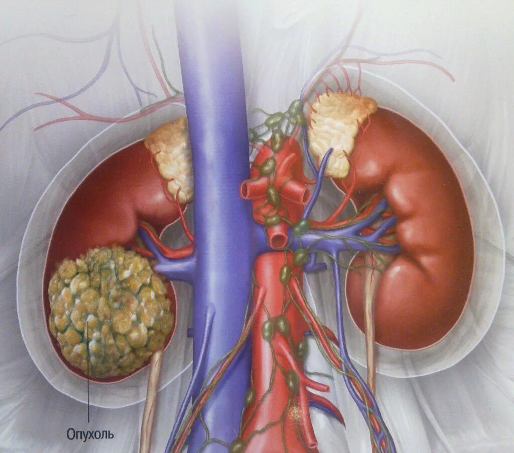 Злокачественная опухоль почки. Раковая опухоль почки с метастазами. Опухоль в капсуле