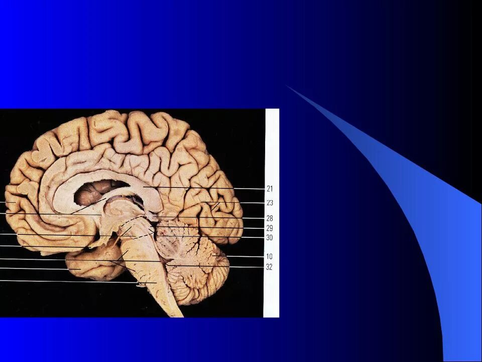 Спайки головного мозга. Передняя и задняя спайка мозга. Задняя спайка головного мозга. Мозолистое тело на препарате. Комиссуральные волокна мозолистого тела.