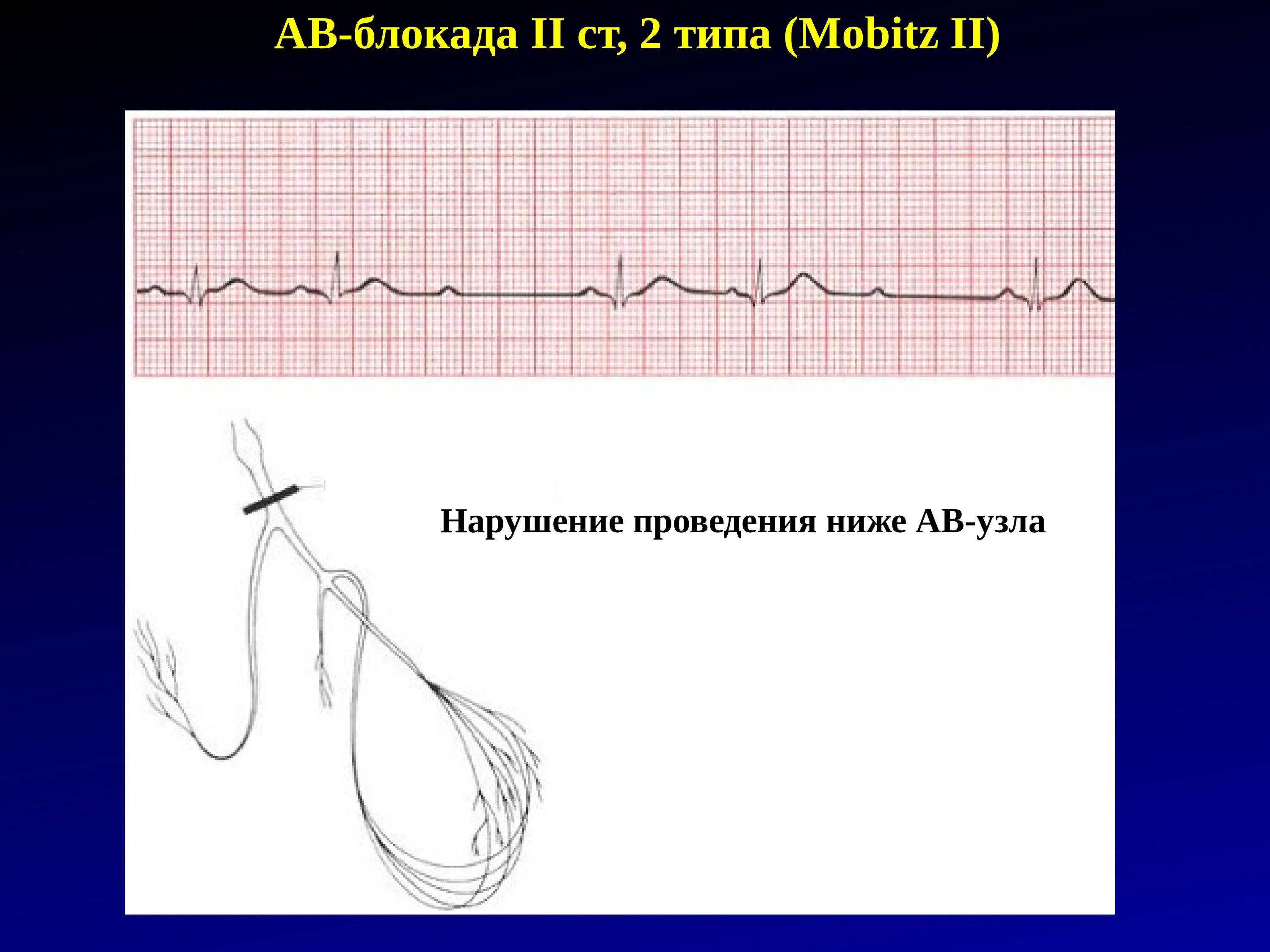 Блокада узла. Экс АВ блокада. Блокада АВ узла. АВ блокада показания к экс. АВ блокада 1 степени Показание для экс.