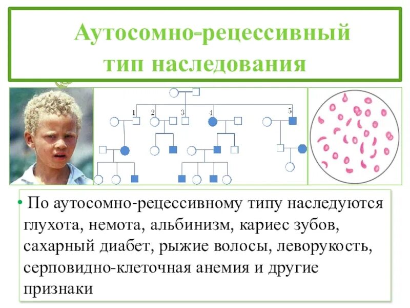 Схема наследования альбинизма. Альбинизм Тип наследования признака. Наследование альбинизма Тип наследования. Альбинизм Тип наследования аутосомно. Кудрявые волосы рецессивный