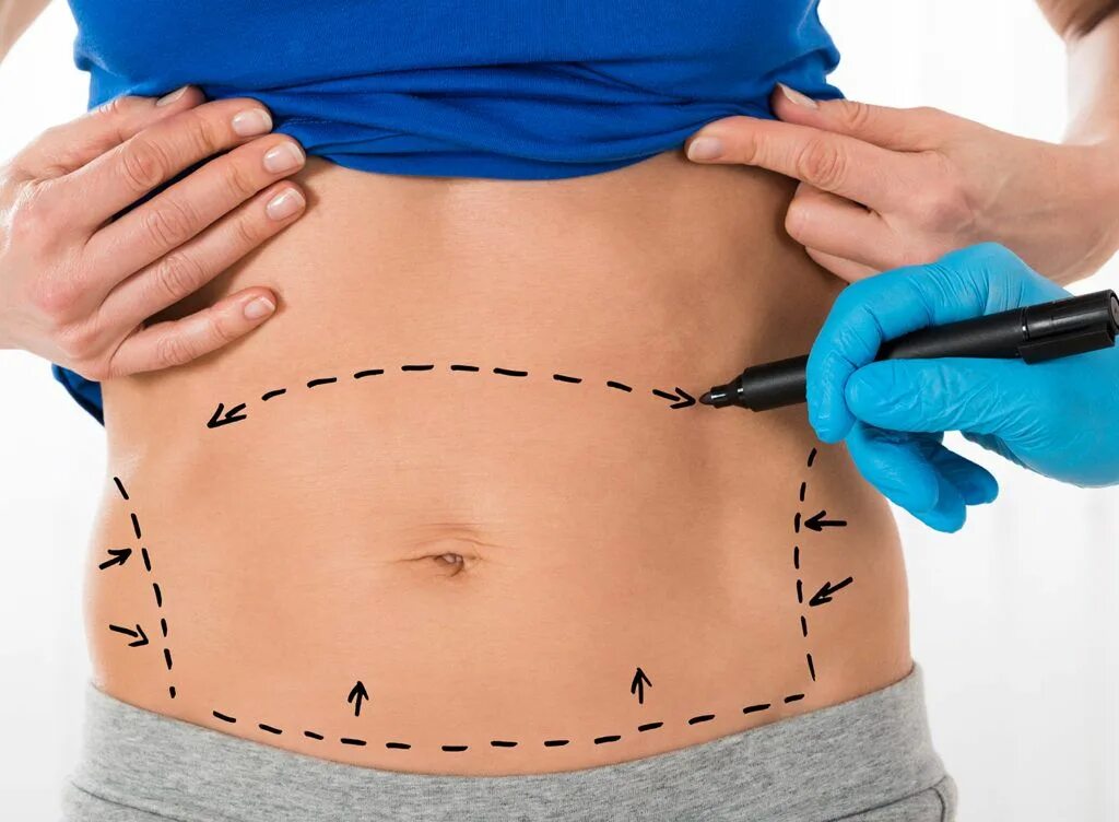 Body surgery. Маммопластика операция. Васер липосакция живота что это. Body surgery. Пластическая хирургия липосакция.