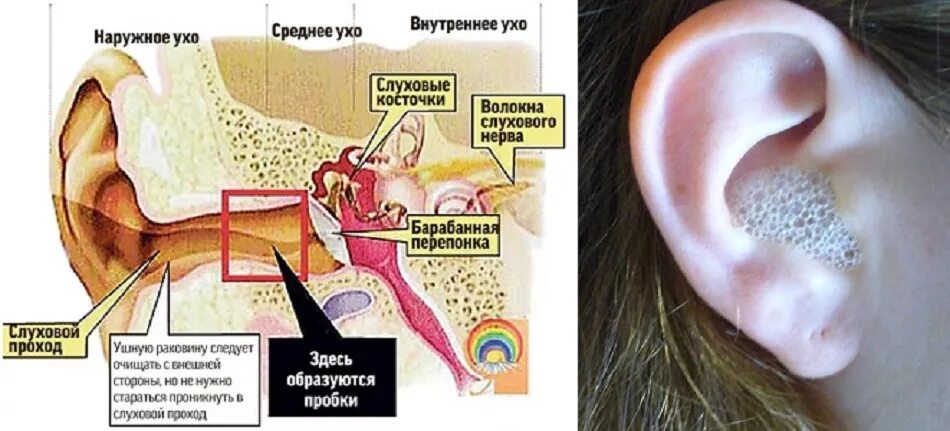 Вода в ухе. Серная пробка в ухе перекись. Ушная пробка перекись водорода. Перекись водорода в ухе. Серная пробка в ухе перекись водорода.