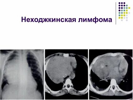 Злокачественная опухоль лимфомы