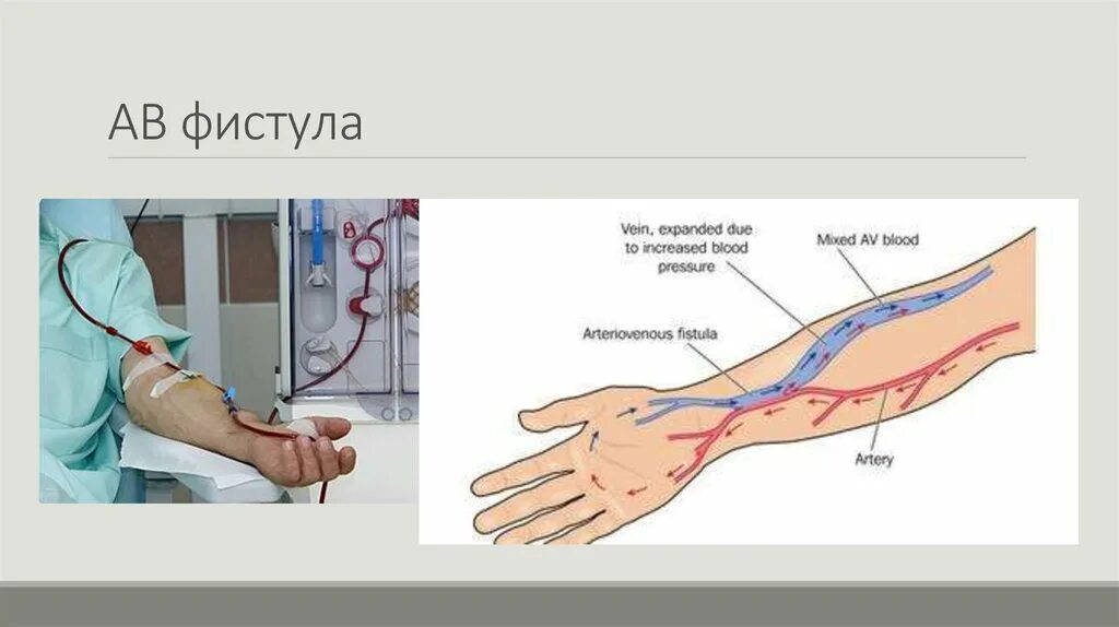 Фистула. Фистула гемодиализ схема. Метод фистул.